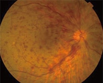 眼底検査の図 網膜中心静脈閉塞症